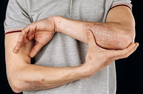 Causes, Symptoms and Treatment for Psoriasis