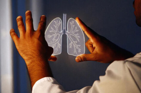 Bronchoscopic Cryotherapy