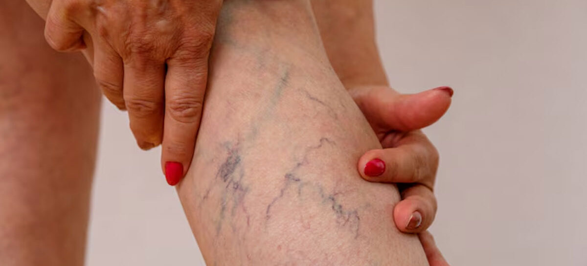 Varicose Veins and Knee Pain