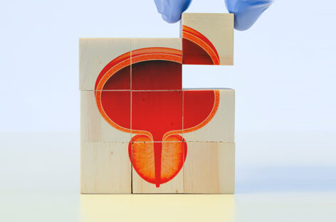Understanding Enlarged Prostate and Parkinsonism: A Common Concern for Men