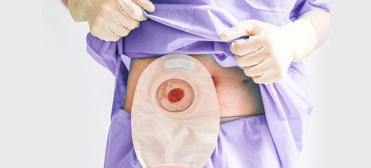 How to change your colostomy bag at home – A step-by-step guide for Crohn’s patients