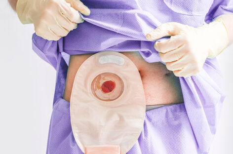 How to change your colostomy bag at home – A step-by-step guide for Crohn’s patients