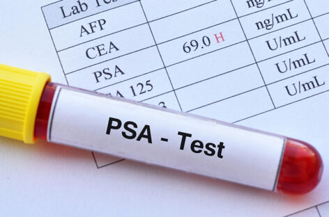 Prostate Health – Understanding Enlargement, Cancer Symptoms and PSA Tests