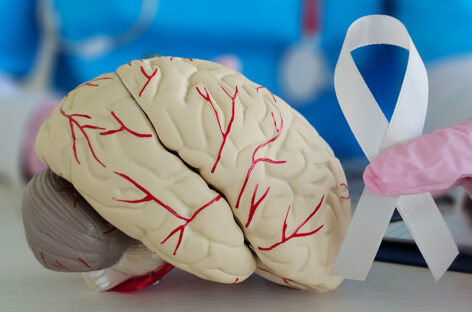 Brain Tumour: Causes, Types, and Symptoms Explained