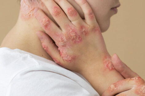 Living with Lupus-Navigating Challenges and Embracing the Journey