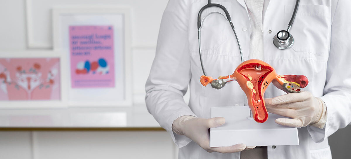 PCOS: All You Need to Know to Conquer It
