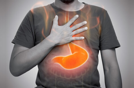 Beat the Burn: How Simple Changes Can Help You Conquer Acid Reflux Naturally