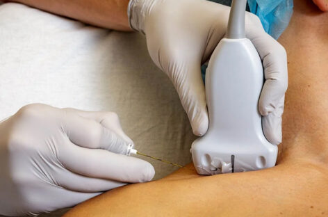 Regional Anaesthesia – A Way for Quick Recovery After Surgery