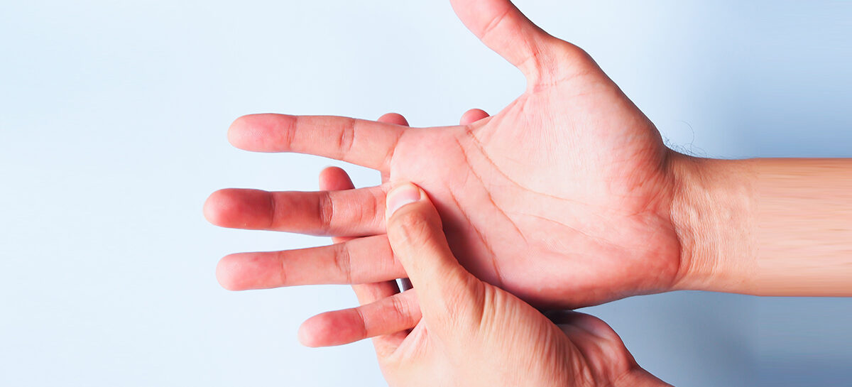 Dupuytren Contractures—A Disease of the Hand