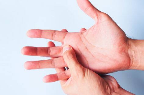Dupuytren Contractures—A Disease of the Hand