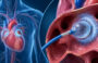 Cryoablation for Atrial Fibrillation – How Does It Work?