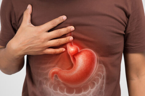 Hiatal Hernia
