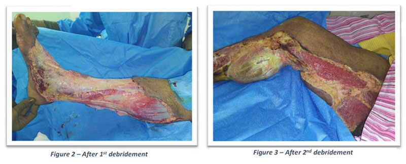 after 1st debridement