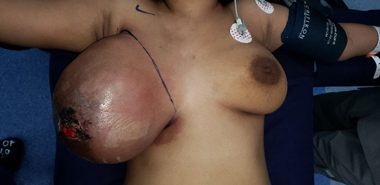 Huge cystosarcoma phylloides