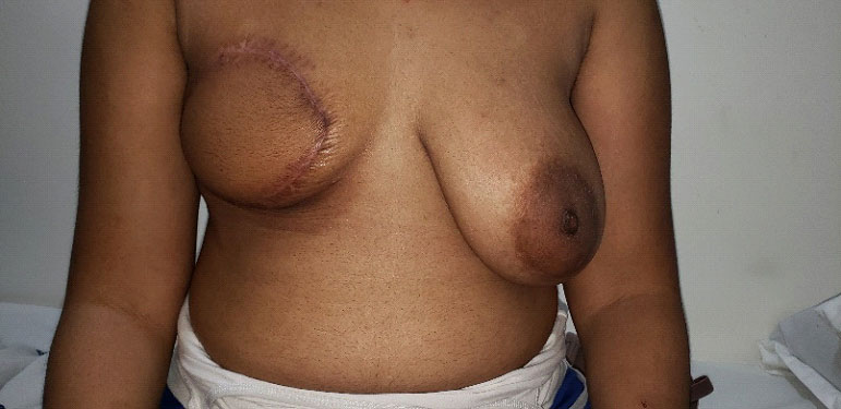 Post mastectomy reconstruction with LD myocutaneous flap