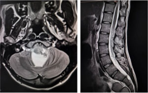 Tumors at Every Corner: Unraveling an NF2 Mystery