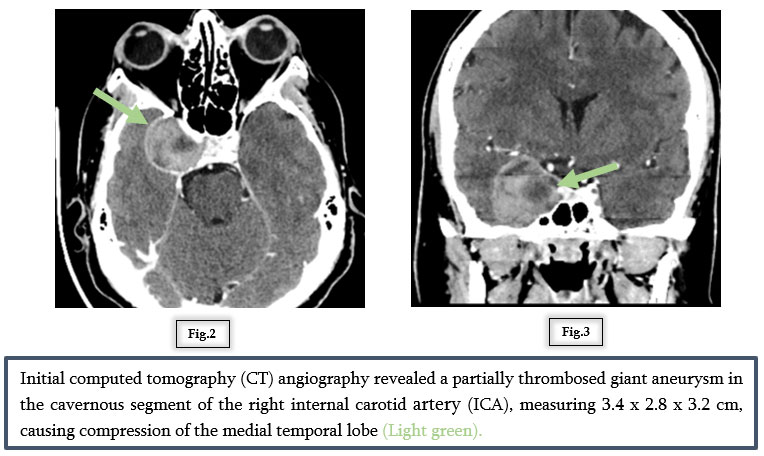 A Vision at Risk: Managing a Cavernous Carotid Aneurysm with Flow Diversion