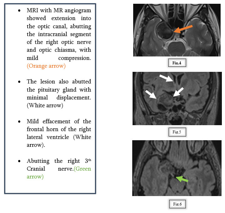 A Vision at Risk: Managing a Cavernous Carotid Aneurysm with Flow Diversion