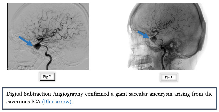 A Vision at Risk: Managing a Cavernous Carotid Aneurysm with Flow Diversion