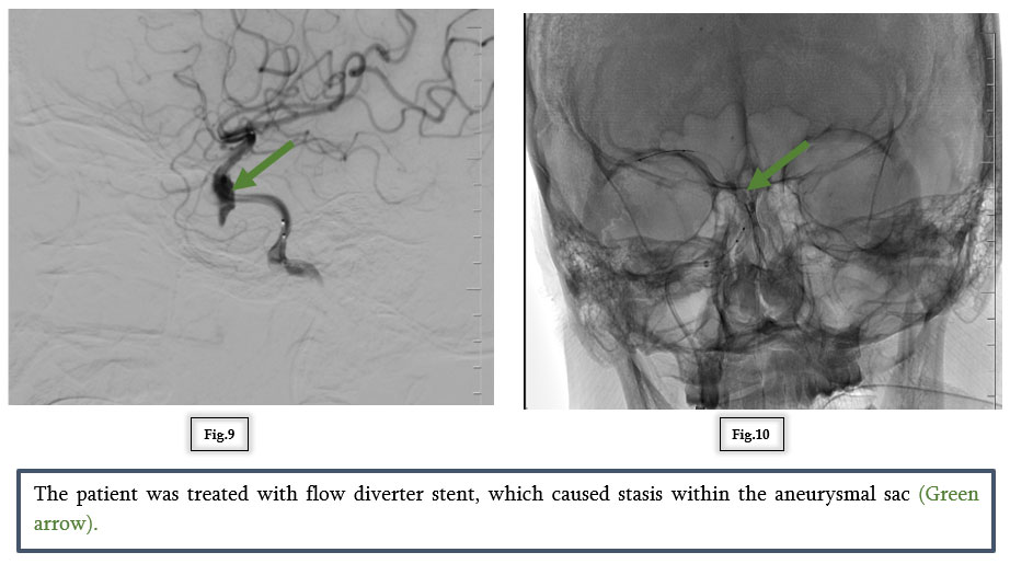 A Vision at Risk: Managing a Cavernous Carotid Aneurysm with Flow Diversion