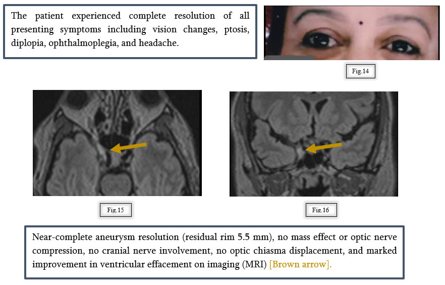 A Vision at Risk: Managing a Cavernous Carotid Aneurysm with Flow Diversion