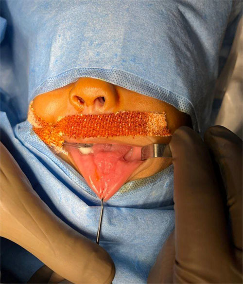 PIERRE ROBIN SEQUENCE (ANAESTHESIA CONSIDERATIONS)