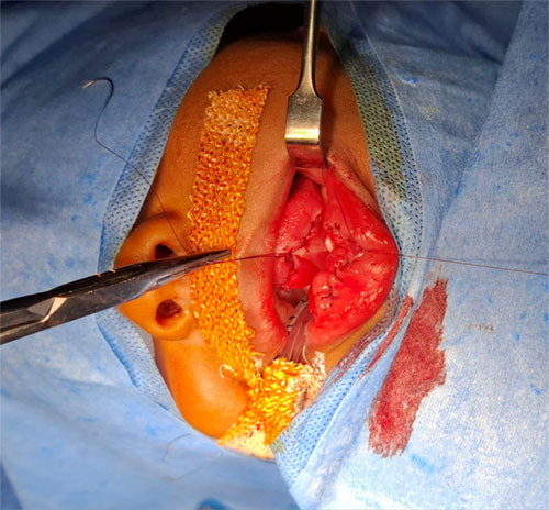 PIERRE ROBIN SEQUENCE (ANAESTHESIA CONSIDERATIONS)