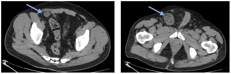 Right Inguinal Hernia With Sigmoid Colon Content: An Embryological Twist