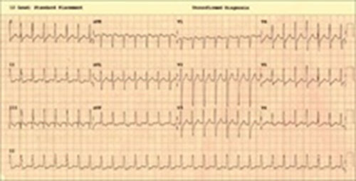 Palpitation In A Post Renal Transplant Scenario