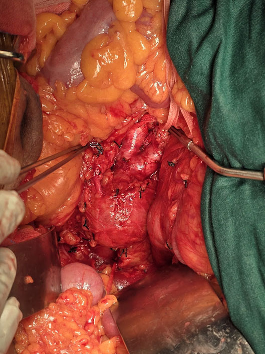 NAVIGATING ANESTHESIA CHALLENGES IN AORTIC ANEURYSM SURGERY