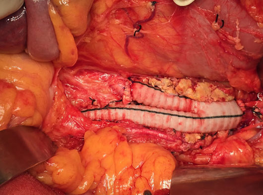 NAVIGATING ANESTHESIA CHALLENGES IN AORTIC ANEURYSM SURGERY