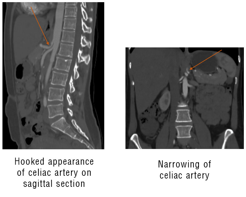Vascular Compression Syndromes: Spotlight on Dunbar Syndrome