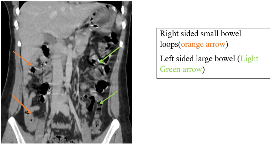 Beyond Gastroenteritis: An Unexpected Diagnosis of Intestinal Malrotation in an Adult
