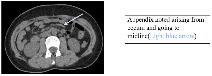 Beyond Gastroenteritis: An Unexpected Diagnosis of Intestinal Malrotation in an Adult