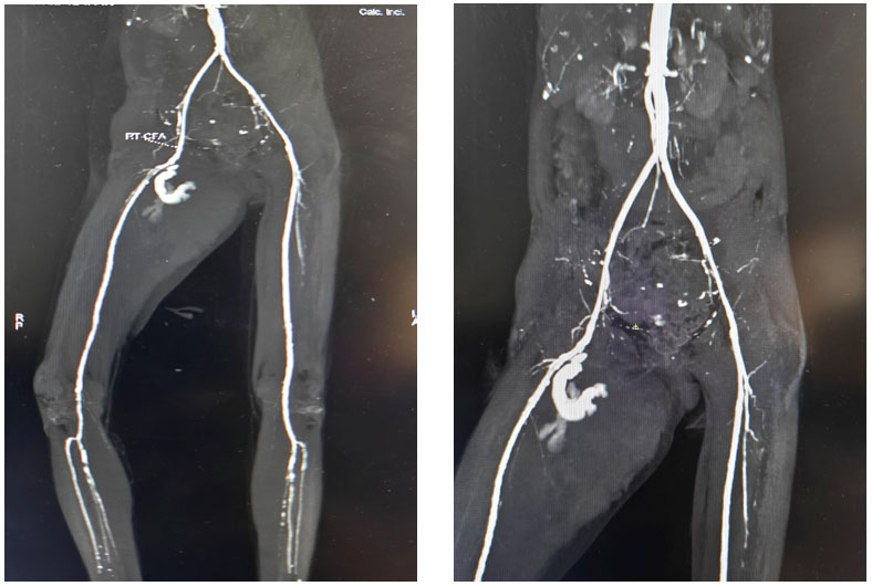 Delayed Spontaneous Rupture of Right Common Femoral Artery Pseudoaneurysm Following PCI: A Rare Cause of Hypovolemic Shock in an Anticoagulated Patient
