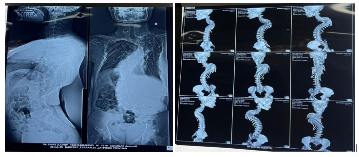 Neuromonitoring with Total Intravenous Anaesthesia using TCI pump using Remifentanyl and Propofol for scoliosis staged correction