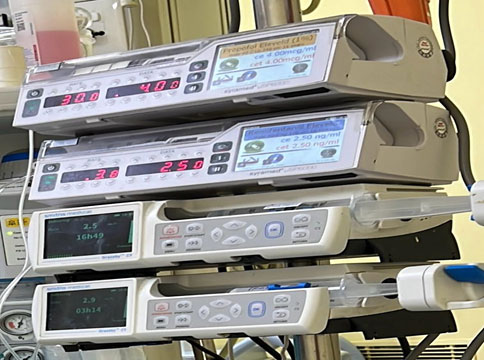 Neuromonitoring with Total Intravenous Anaesthesia using TCI pump using Remifentanyl and Propofol for scoliosis staged correction