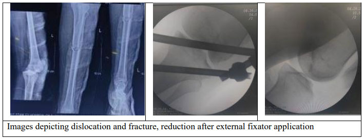 Rare Combination of Knee Dislocation, Ipsilateral Leg Fractures, and Patellar Tendon Rupture: Case Report and Review