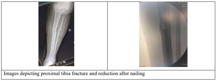 Rare Combination of Knee Dislocation, Ipsilateral Leg Fractures, and Patellar Tendon Rupture: Case Report and Review