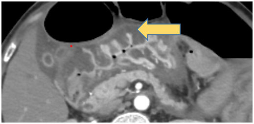 Edematous submucosa