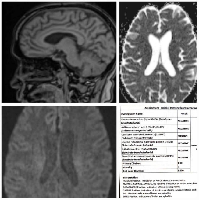 MRI Brain Images- Normal; Autoimmune Encephalitis panel- Positive for CASPR2