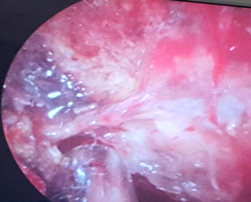 COVID-19-and-Mucormycosis-1