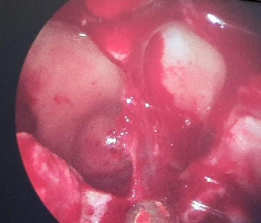 COVID-19-and-Mucormycosis-4