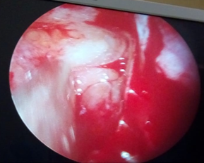 COVID-19-and-Mucormycosis-5