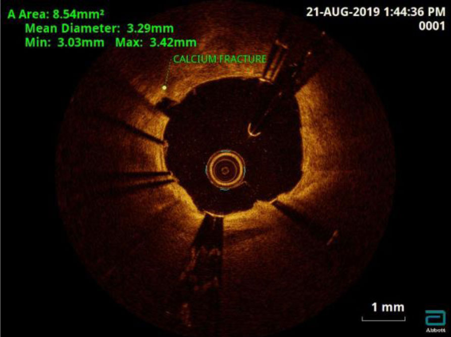 intracoronary-imaging-11