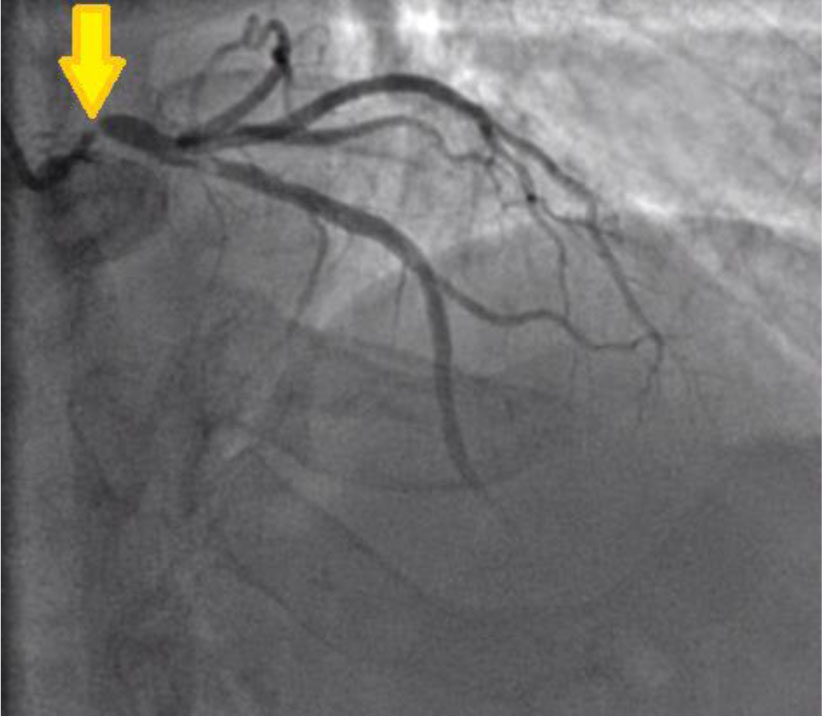 intracoronary-imaging-2