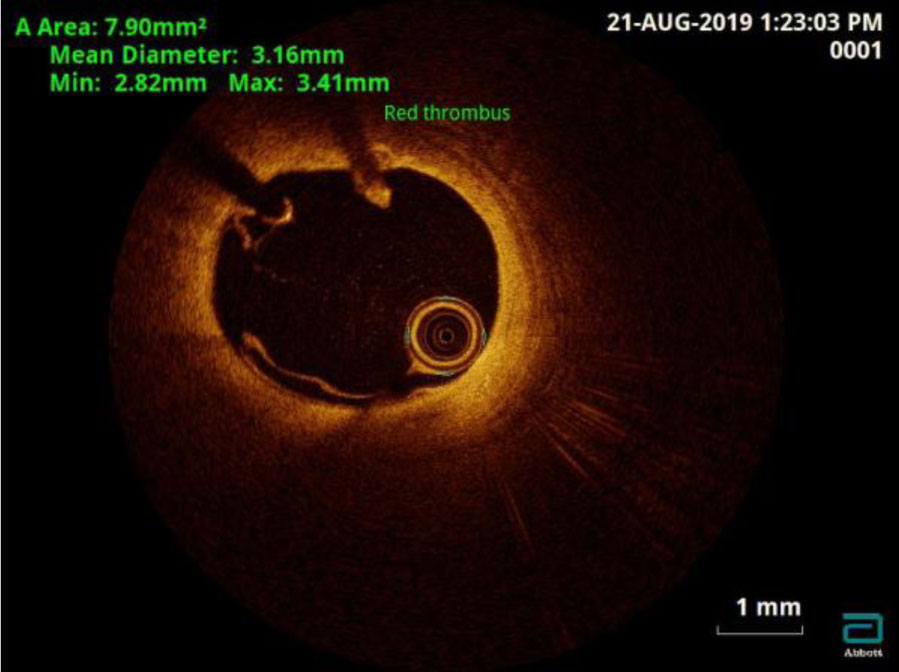 intracoronary-imaging-8
