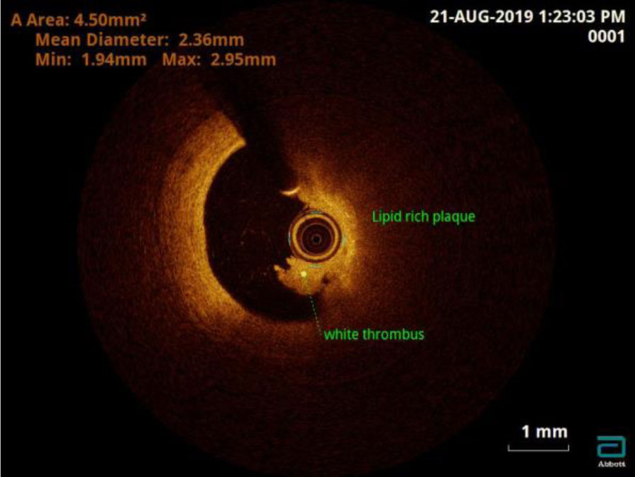 intracoronary-imaging-9