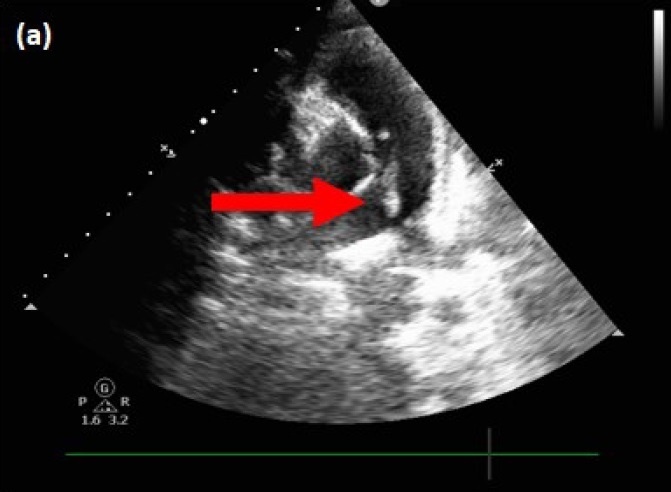 pulmonary-valve-endocarditis-image-a