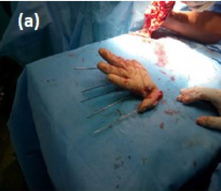 upper-limb-fig-2-a